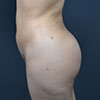 View from left side after liposuction surgery performed on a 16 year old patient.