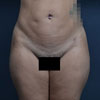 View before and after photos of the Liposuction results performed by Dr. Rajae Janho of Atlanta, GA.