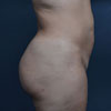 View before and after photos of the Liposuction results performed by Dr. Rajae Janho of Atlanta, GA.