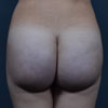 3D Liposculpture