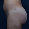 3d Liposculpture - Liposuction - Performed by Doctor Rajae Janho at Bella Forma Cosmetic Surgery Center