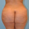 Brazilian Butt Lift surgery performed at Bella Forma Cosmetic Surgery and Med Spa in Atlanta, GA.