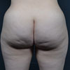 3D Liposculpture - Liposuction - Back - Performed by Doctor Rajae Janho at Bella Forma Cosmetic Surgery Center, Atlanta, GA