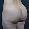 3D Liposculpture - Liposuction - Left Side - Performed by Doctor Rajae Janho at Bella Forma Cosmetic Surgery Center, Atlanta, GA