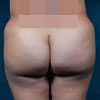 3D Liposculpture - Liposuction - Back - Performed by Doctor Rajae Janho at Bella Forma Cosmetic Surgery Center, Atlanta, GA