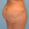 Atlanta Brazilian Butt Lift performed by Dr. Rajae Janho at Bella Forma Cosmetic Surgery Center and Med Spa.