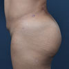 3D Liposculpture - Liposuction - Left Side - Performed by Doctor Rajae Janho at Bella Forma Cosmetic Surgery Center, Atlanta, GA