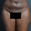 3D Liposculpture - Liposuction - Front - Performed by Doctor Rajae Janho at Bella Forma Cosmetic Surgery Center, Atlanta, GA