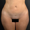 3D Liposculpture - Liposuction - Front - Performed by Doctor Rajae Janho at Bella Forma Cosmetic Surgery Center, Atlanta, GA