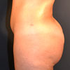 3D Liposculpture - Liposuction - Left Side - Performed by Doctor Rajae Janho at Bella Forma Cosmetic Surgery Center, Atlanta, GA