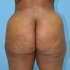 Brazilian Butt Lift performed by Dr. Rajae Janho at Bella Forma Cosmetic Sugery Center and Med Spa.