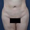 3D Liposculpture - Liposuction - Front - Performed by Doctor Rajae Janho at Bella Forma Cosmetic Surgery Center, Atlanta, GA