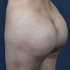 3D Liposculpture - Liposuction - Left Side - Performed by Doctor Rajae Janho at Bella Forma Cosmetic Surgery Center, Atlanta, GA