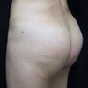 3D Liposculpture - Liposuction - Left Side - Performed by Doctor Rajae Janho at Bella Forma Cosmetic Surgery Center, Atlanta, GA