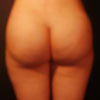 3D Liposculpture - Liposuction - Back - Performed by Doctor Rajae Janho at Bella Forma Cosmetic Surgery Center, Atlanta, GA