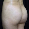 3D Liposculpture - Liposuction - Left Side - Performed by Doctor Rajae Janho at Bella Forma Cosmetic Surgery Center, Atlanta, GA