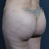 Brazilian butt lift surgery performed to reshape and add projection of buttocks.