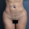 3D Liposculpture - Liposuction - Front - Performed by Doctor Rajae Janho at Bella Forma Cosmetic Surgery Center, Atlanta, GA