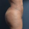 3D Liposculpture - Liposuction - Right Side - Performed by Doctor Rajae Janho at Bella Forma Cosmetic Surgery Center, Atlanta, GA