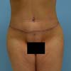 Brazilian Abdominoplasty Tummy Tuck surgery at Bella Forma Cosmetic Surgery Center - Atlanta GA.