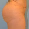 Brazilian Abdominoplasty Tummy Tuck surgery in Atlanta GA at Bella Forma Cosmetic Surgery Center by Dr. Rajae Janho.