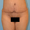 Abdominoplasty Tummy Tuck surgery at Bella Forma Cosmetic Surgery Center - Atlanta GA.