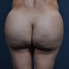 Brazilian Butt Lift procedure before and after pictures.