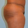 Brazilian Abdominoplasty Tummy Tuck surgery in Atlanta GA at Bella Forma Cosmetic Surgery Center by Dr. Rajae Janho.