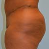 Brazilian Abdominoplasty Tummy Tuck surgery in Atlanta GA.