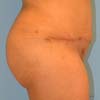 Brazilian Abdominoplasty Tummy Tuck surgery in Atlanta GA on a 35 years old patient with no children.
