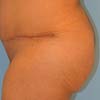 Brazilian Abdominoplasty Tummy Tuck surgery in Atlanta GA performed on a 35 years old patient with no children.