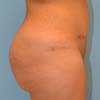 Tummy Tuck performed on a 26 years old patient mother of three. (Right)