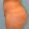 Brazilian Abdominoplasty Tummy Tuck surgery in Atlanta GA
