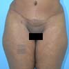 Brazilian Tummy Tuck performed on a patient forty- two-year- old mother of three children,