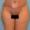 Brazilian Tummy Tuck surgery performed in a 44 years old patient mother of 3. (Front)