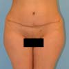 Tummy Tucks: Abdominoplasty Surgery