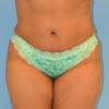 Brazilian Abdominoplasty Tummy Tuck Surgery performed on a patient with 38-year-old mother of two. 3 months post op.