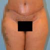Brazilian Abdominoplasty Tummy Tuck Surgery performed in Atlanta on a patient with 42-year-old mother of three. 1 month post op.