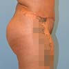Abdominoplastia o cirugía del abdomen