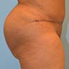 Tummy Tuck Brazilian Abdominoplasty in Atlanta, GA