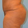 Brazilian Abdominoplasty Tummy Tuck Surgery performed on a patient with 45-year-old mother of two. 2 months post op.