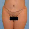Tummy Tuck Surgery performed on a patient with 36-year-old mother of three, 6 months post op.