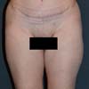 Brazilian Tummy Tuck Surgery performed on a patient with 35-year-old mother of three, 1 month pos op.