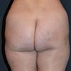 Brazilian Abdominoplasty Tummy Tuck Surgery