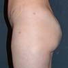 Tummy Tuck Surgery performed on a patient with 45-year-old mother of three.