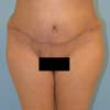 Tummy Tuck Surgery performed on a patient with 38-year-old mother of two.