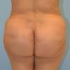 Tummy Tuck, Abdominoplasty - Back