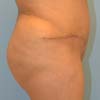 Tummy Tuck, Abdominoplasty - Right
