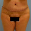 Brazilian Abdominoplasty, tummy tuck performed on a patient with 45-year-old mother of three.