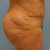Brazilian Abdominoplasty Surgery Right Side.